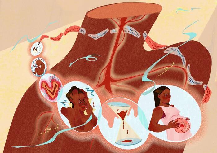 Illustration artwork representing a person with sickle cell anaemia, showing their struggles, symptoms, and feeling isolated within a healthcare system not built for their needs.